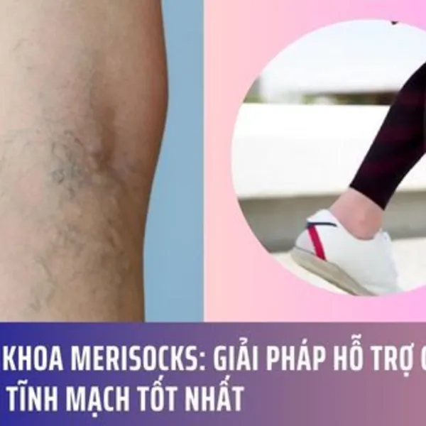 Vớ Y Khoa Merisocks: Giải Pháp Hỗ Trợ Chống Giãn Tĩnh Mạch Tốt Nhất