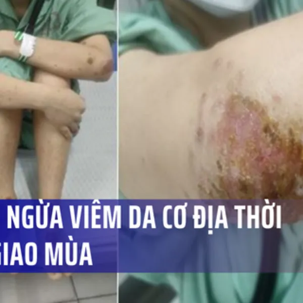 Phòng ngừa viêm da cơ địa thời điểm giao mùa