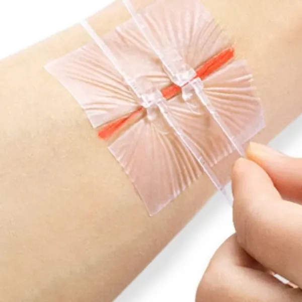 Kỹ thuật đóng vết thương kiểu khoá kéo mới được sử dụng trong các thủ tục phẫu thuật