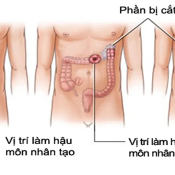 Đặc điểm Đế bằng HẬU MÔN NHÂN TẠO có viền băng keo