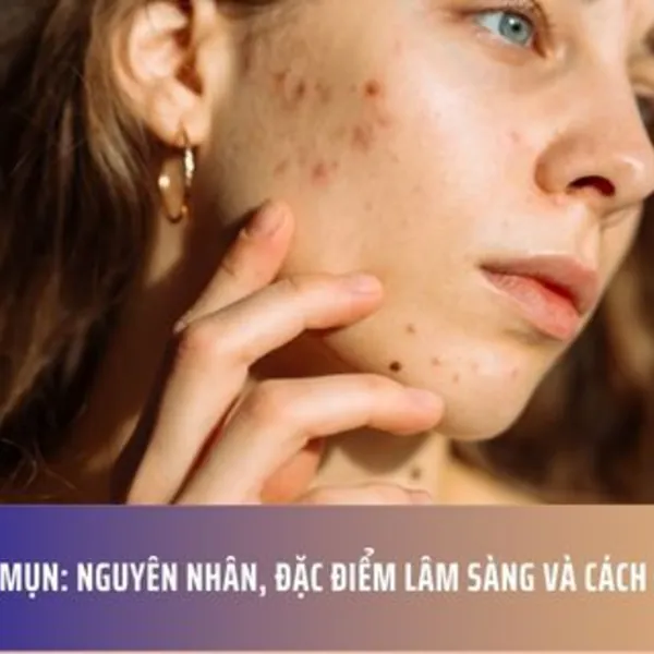 Sẹo do mụn: Nguyên nhân, đặc điểm lâm sàng và cách điều trị