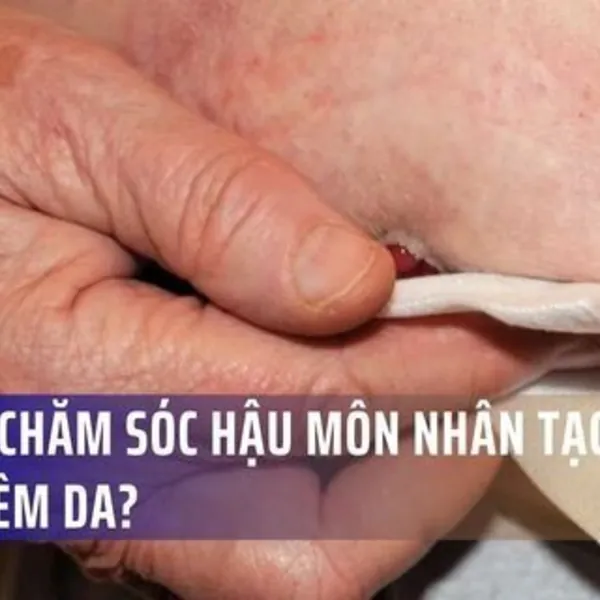 Vì sao chăm sóc hậu môn nhân tạo mãi vẫn viêm da? ThS.BS CKII BV Việt Đức lý giải