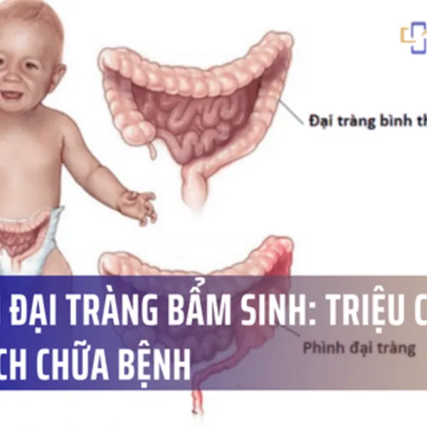 Phình đại tràng bẩm sinh: triệu chứng và cách chữa bệnh