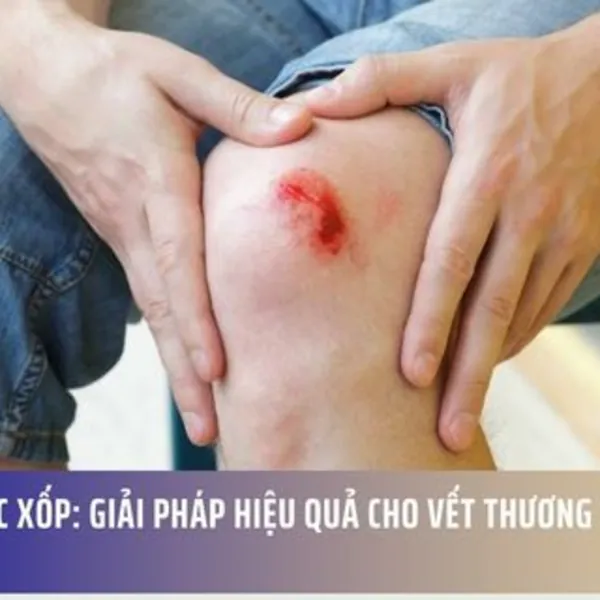 Băng Gạc Xốp: Giải Pháp Hiệu Quả Cho Vết Thương Tiết Dịch