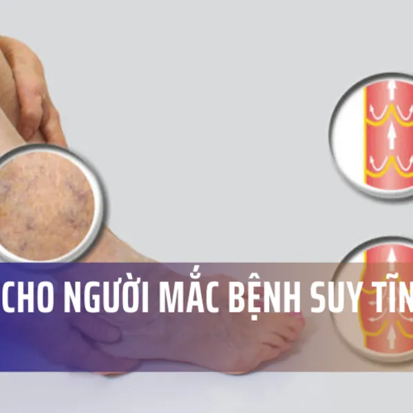 Bài tập cho người mắc bệnh suy tĩnh mạch chân