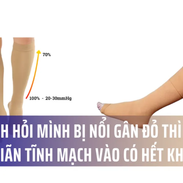Cho mình hỏi mình bị nổi gân đỏ thì đeo vớ chống giãn tĩnh mạch vào có hết không?
