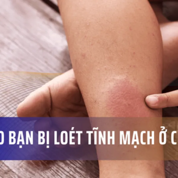 Tại sao bạn bị loét tĩnh mạch ở chân?