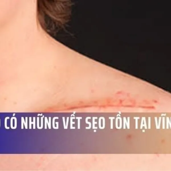 Tại sao có những vết sẹo tồn tại vĩnh viễn?