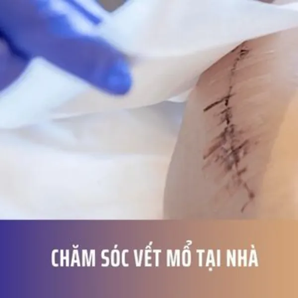 Chăm Sóc Vết Mổ Tại Nhà