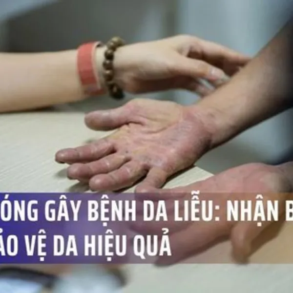Nắng Nóng Đầu Mùa Làm Bùng Phát Bệnh Da Liễu: Cách Phòng Tránh Hiệu Quả