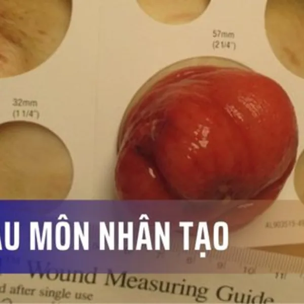 Sa hậu môn nhân tạo là gì?