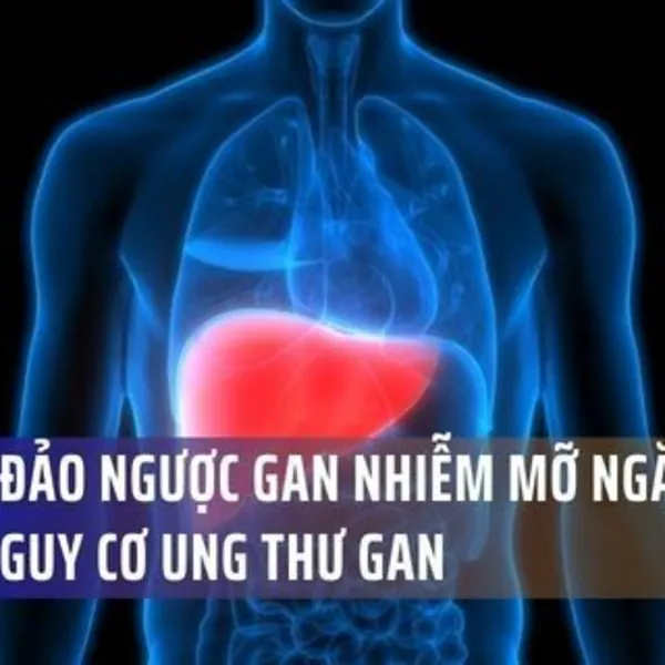 5 Bước Đảo Ngược Gan Nhiễm Mỡ Từ Chuyên Gia, Ngăn Ngừa Nguy Cơ Ung Thư Gan