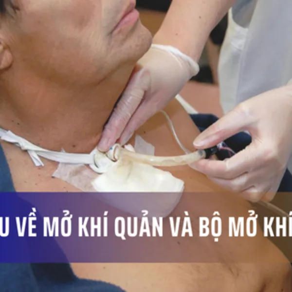 Tìm hiểu về mở khí quản và bộ mở khí quản