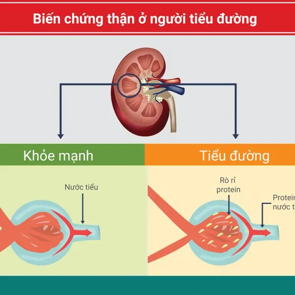 Bệnh thận đái tháo đường là gì? Cách phòng ngừa và điều trị bệnh thận đái tháo đường