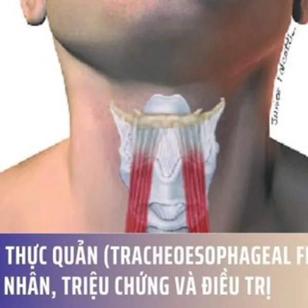 Rò khí - thực quản (Tracheoesophageal Fistula): Nguyên nhân, triệu chứng và điều trị