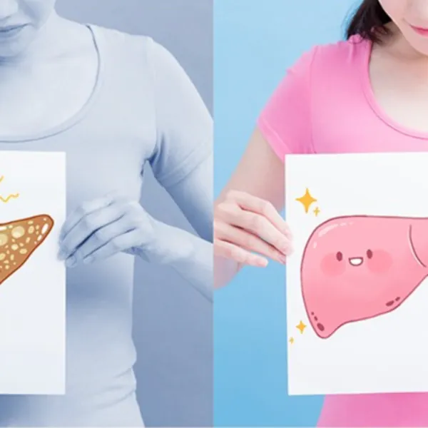 FDA phê duyệt loại thuốc đầu tiên điều trị sẹo gan do bệnh gan nhiễm mỡ