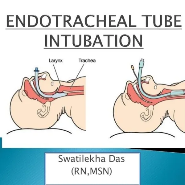 Tiến bộ công nghệ trong ống nội khí quản ngăn ngừa sự thoát dịch rỉ