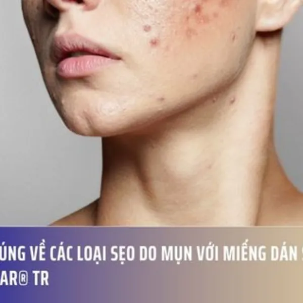 Hiểu Đúng Về Các Loại Sẹo Do Mụn Với Miếng Dán Silicone RemScar® TR