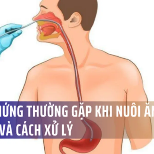 Biến chứng thường gặp khi cho ăn bằng sonde dạ dày và Cách xử trí