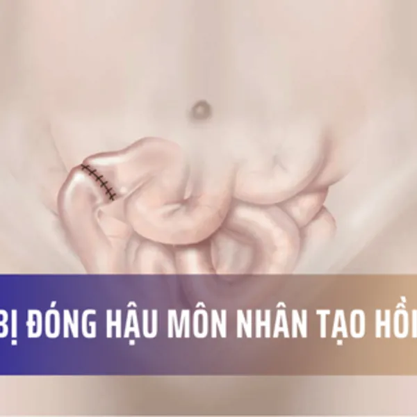 Phẫu thuật đóng hậu môn nhân tạo hồi tràng cần chuẩn bị gì?