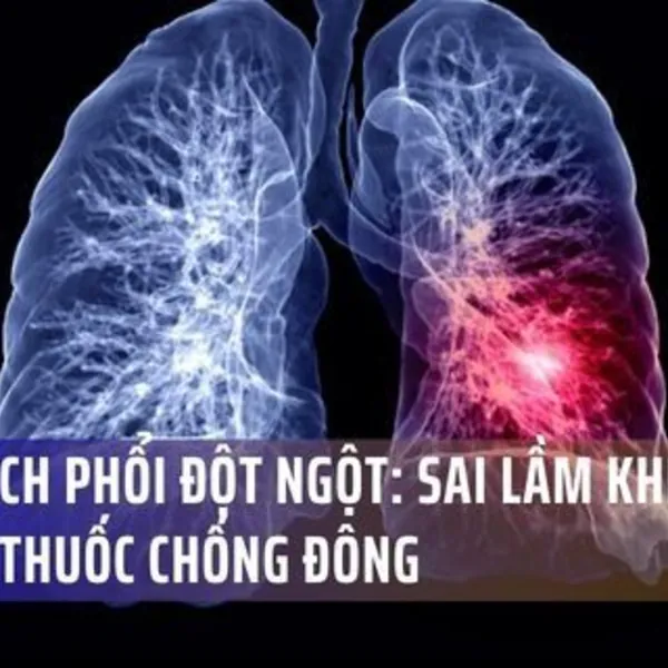 Hiểm Họa Tắc Mạch Phổi Đột Ngột: Sai Lầm Chết Người Khi Tự Ý Ngừng Thuốc Chống Đông