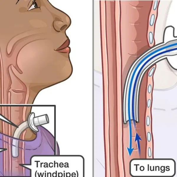 Phân biệt các loại ống mở khí quản trẻ em