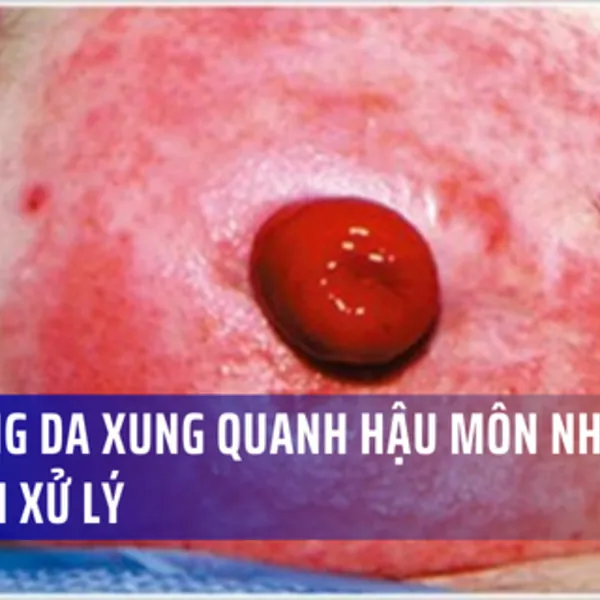 Cách xử lý kích ứng vùng da xung quanh hậu môn nhân tạo