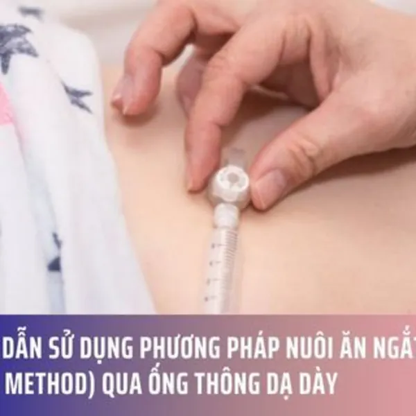 Hướng Dẫn Sử Dụng Phương Pháp Nuôi Ăn Ngắt Quãng (Bolus Method) Qua Ống Thông Dạ Dày