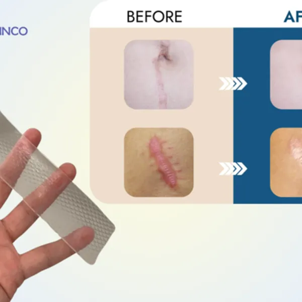 Vì sao sẹo lồi ngày càng to? Sản phẩm trị sẹo lồi hiệu quả