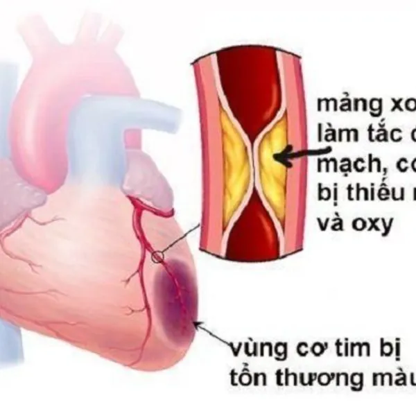 Cao huyết áp – Bạn cần biết???