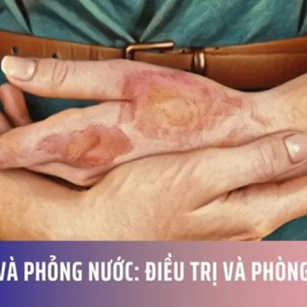 Bỏng và Phỏng Nước: Điều Trị và Phòng Ngừa