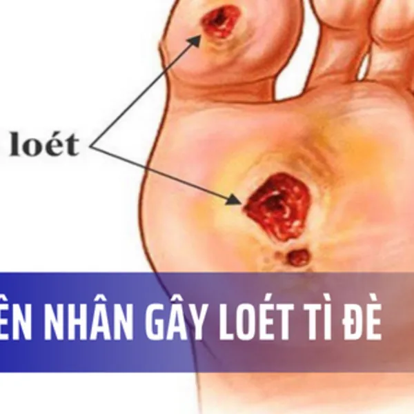 Loét da do tì đè - Nguyên nhân và các yếu tố nguy cơ