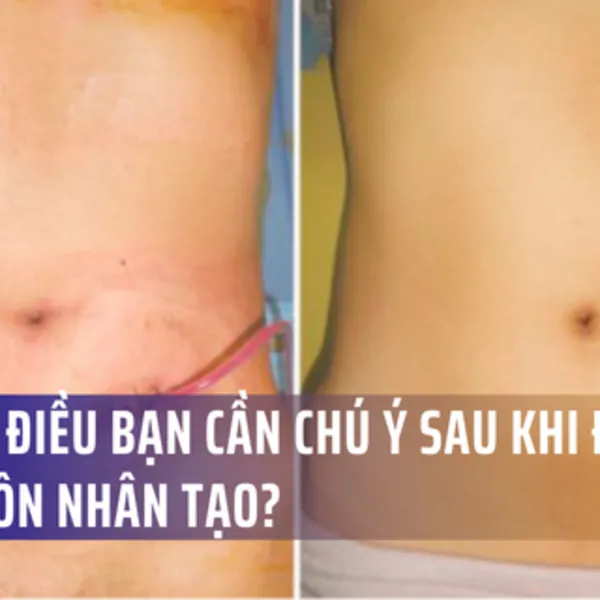 Điều gì xảy ra sau phẫu thuật đóng hậu môn nhân tạo?