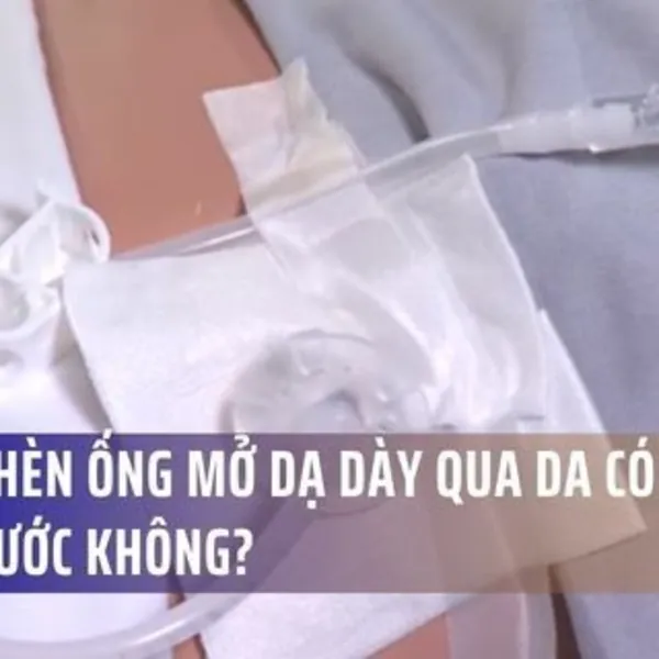 Bóng chèn ống mở dạ dày qua da có cần thay nước không?