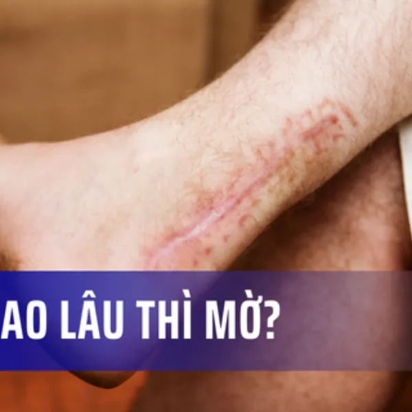 Sẹo bao lâu thì mờ? Cách làm mờ sẹo hiệu quả