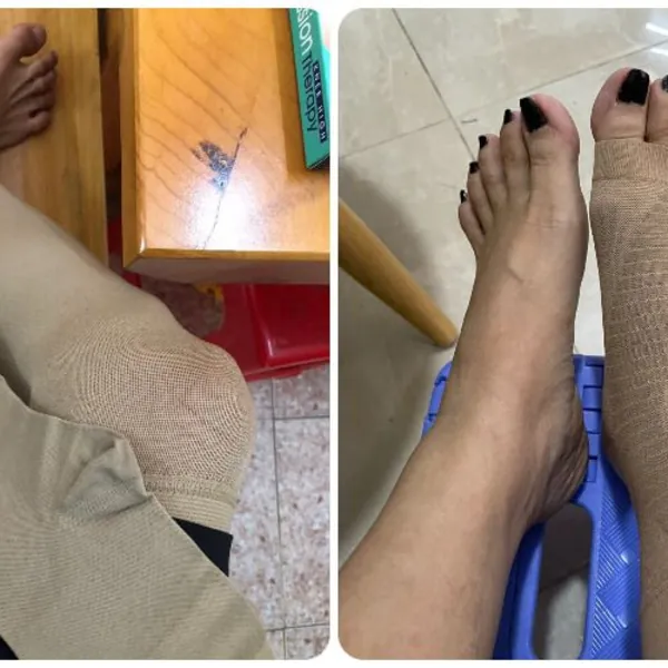 Sử dụng vớ nén và tất nén cho các bệnh tĩnh mạch ở bệnh nhân có nguy cơ cao