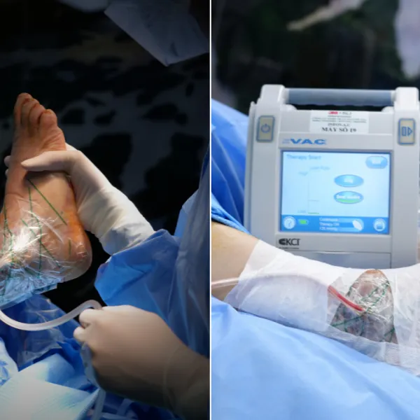 Khuyến cáo lâm sàng và hướng dẫn thực hành điều trị vết thương áp lực âm kết hợp việc tưới vết thương