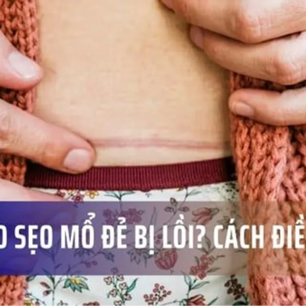 Tại sao vết sẹo mổ đẻ bị lồi? Cách điều trị sẹo lồi vết mổ sau sinh hiệu quả