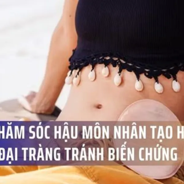 Bác sĩ Bệnh viện Việt Đức chia sẻ cách chăm sóc hậu môn nhân tạo hồi tràng đại tràng tránh biến chứng