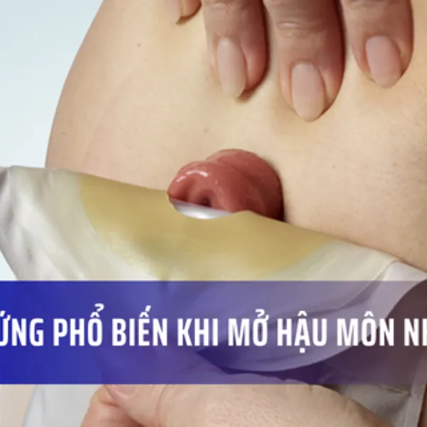 Các biến chứng phổ biến khi dùng túi Hậu môn nhân tạo