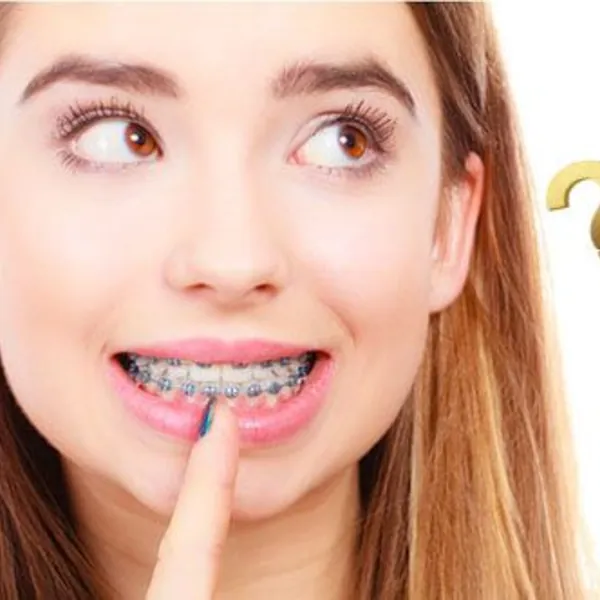 Người niềng răng có nên sử dụng Máy tăm nước hay không?