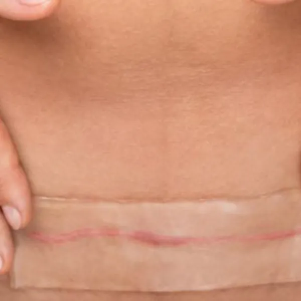 Miếng dán silicone để quản lý sẹo sau phẫu thuật thẩm mỹ