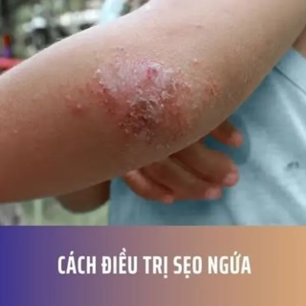 Cách Điều Trị Sẹo Ngứa