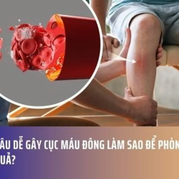 Ngồi Lâu Dễ Gây Cục Máu Đông Làm Sao Để Phòng Ngừa Hiệu Quả?