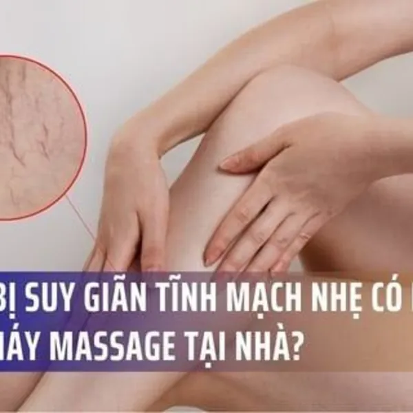 Người bị suy giãn tĩnh mạch nhẹ có nên dùng máy massage (máy xoa bóp) tại nhà?