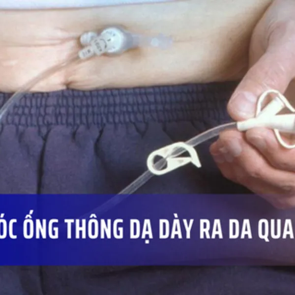 Chăm sóc ống thông dạ dày ra da qua nội soi (PEG)