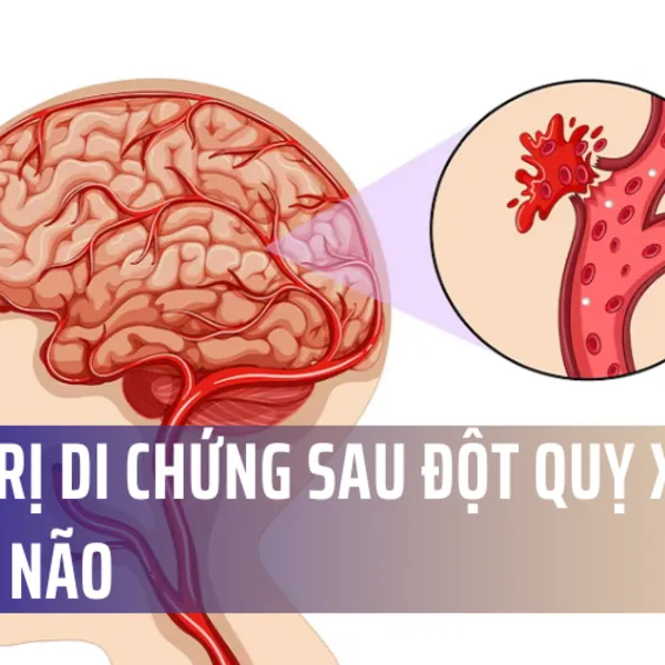 Điều trị di chứng sau đột quỵ xuất huyết não