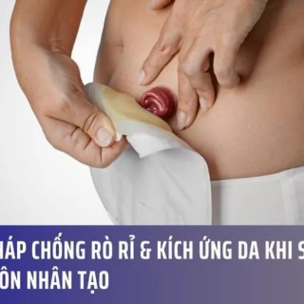 Giải Pháp Chống Rò Rỉ & Kích ứng Da Khi Sử Dụng Hậu Môn Nhân Tạo