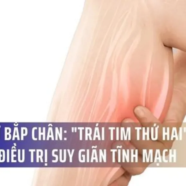 Bơm Cơ Bắp Chân (Calf Pump): "Trái Tim Thứ Hai" Trong Điều Trị Suy Giãn Tĩnh Mạch