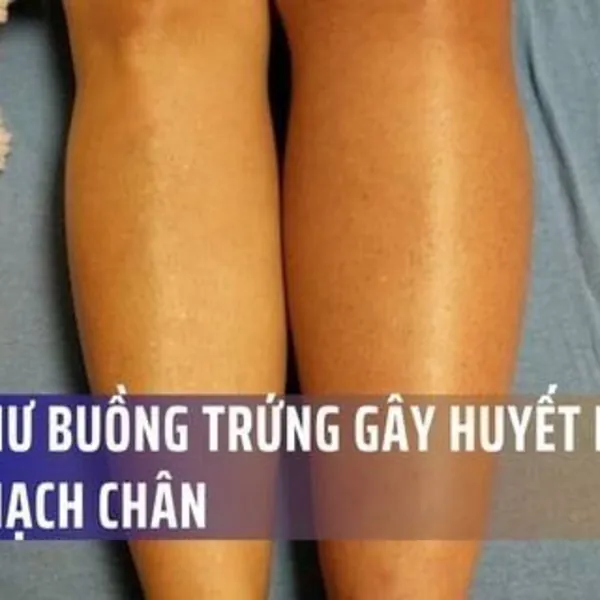 Ung thư buồng trứng gây huyết khối tĩnh mạch chân